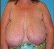 Breast Reduction before and after - before