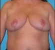 Breast Reduction before and after - after
