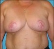 Breast Reduction before and after - after
