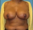 Breast Reduction before and after - after