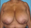 Breast Reduction before and after - before
