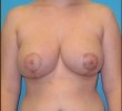 Breast Reduction before and after - after
