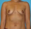 Breast Augmentation before and after - before