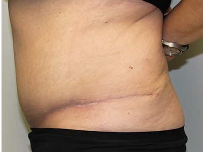 Fleur-de-lis-Abdominoplasty (Tummy Tuck) before and after - after