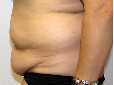 Fleur-de-lis-Abdominoplasty (Tummy Tuck) before and after - before