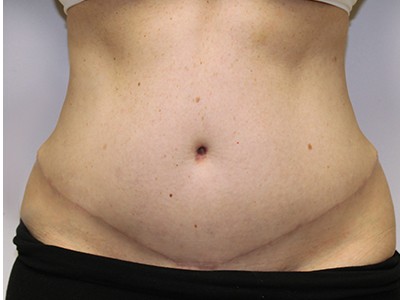 Abdominoplasty (Tummy Tuck) with Flank and Abdominal Liposuction before and after - after