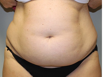 Abdominoplasty (Tummy Tuck) with Flank and Abdominal Liposuction before and after - before