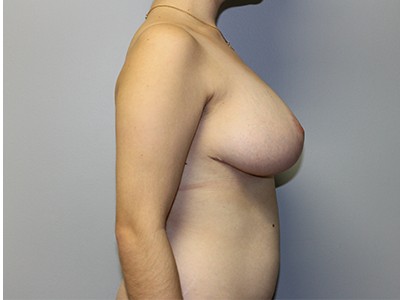 Bilateral Breast Reduction before and after - after
