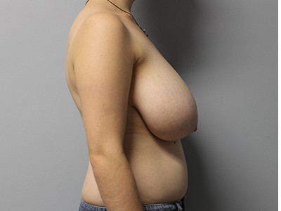 Bilateral Breast Reduction before and after - before