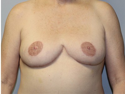 Bilateral Mastectomy with DIEP Flap Nipple Reconstruction and Tattoo before and after - after