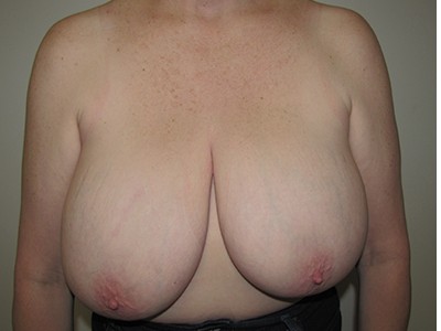 Bilateral Mastectomy with DIEP Flap Nipple Reconstruction and Tattoo before and after - before