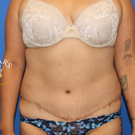 Tummy Tuck before and after - after