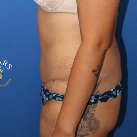 Tummy Tuck before and after - after
