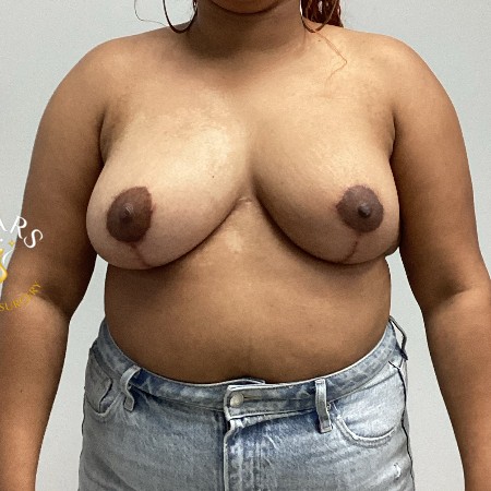 Breast Reduction before and after - after