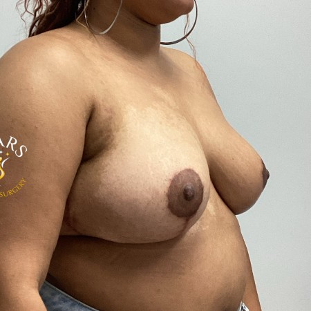 Breast Reduction before and after - after