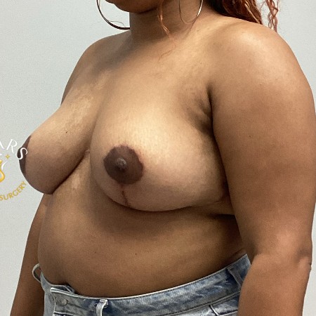 Breast Reduction before and after - after