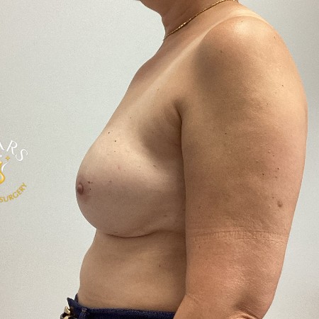 Nipple sparing mastectomy with tissue expanders and silicone implants before and after - after