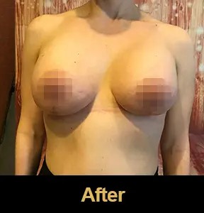 Breast Augmentation before and after - after