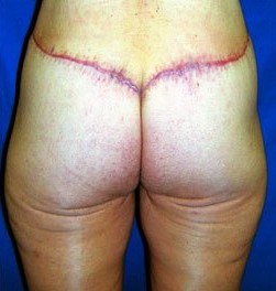 Body Contouring before and after - after