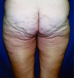 Body Contouring before and after - before