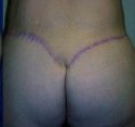Body Contouring before and after - after