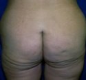 Body Contouring before and after - before