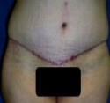 Body Contouring before and after - after