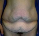 Body Contouring before and after - before
