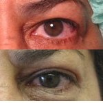 Eyelid Surgery before and after - after