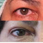 Eyelid Surgery before and after - before