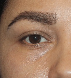 Belotero before and after - before