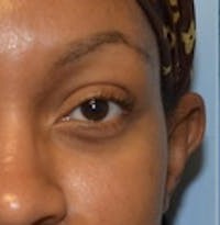 Blepharoplasty before and after - after