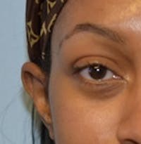 Blepharoplasty before and after - before