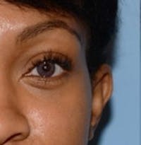 Blepharoplasty before and after - after