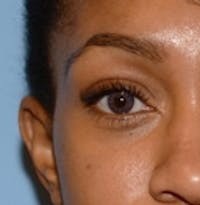 Blepharoplasty before and after - before