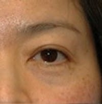 Blepharoplasty before and after - after