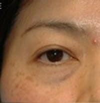 Blepharoplasty before and after - before