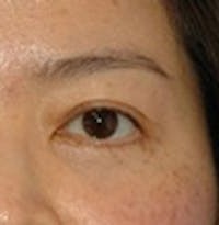 Blepharoplasty before and after - after