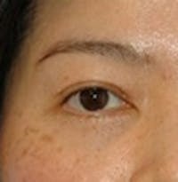 Blepharoplasty before and after - before
