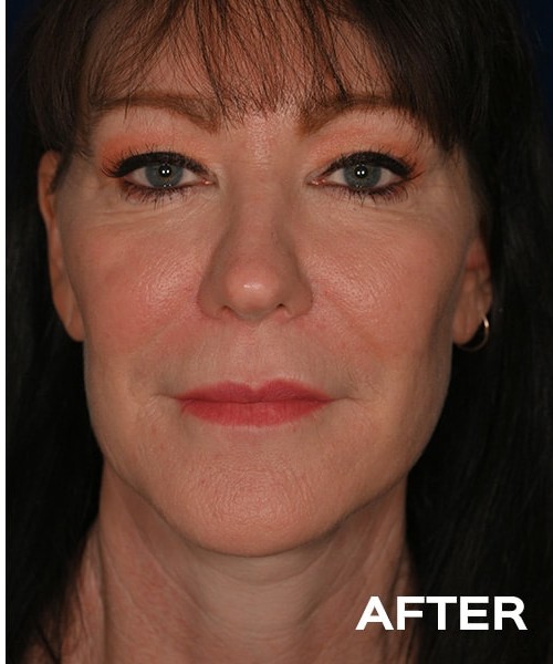 Deep Plane Cheek and Neck Lift before and after - after