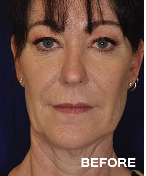 Deep Plane Cheek and Neck Lift before and after - before