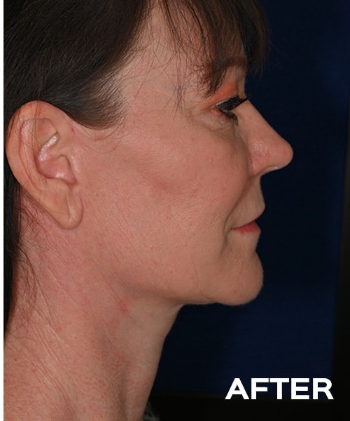 Deep Plane Cheek and Neck Lift before and after - after