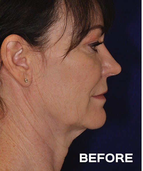 Deep Plane Cheek and Neck Lift before and after - before