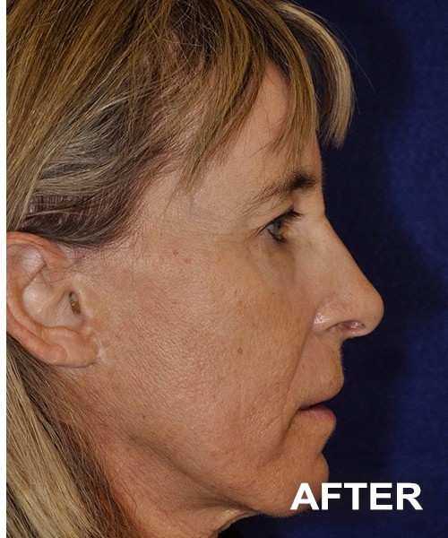 Morpheus 8 Facial Procedure before and after - after
