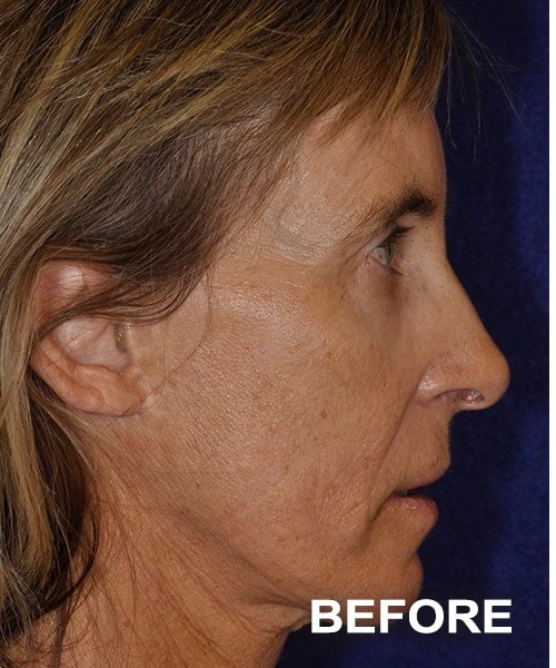 Morpheus 8 Facial Procedure before and after - before