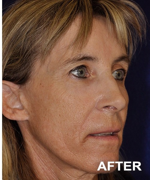 Morpheus 8 Facial Procedure before and after - after