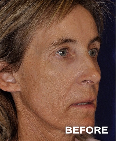 Morpheus 8 Facial Procedure before and after - before