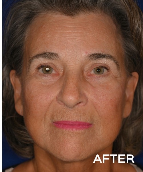 Deep Plane Facelift before and after - after