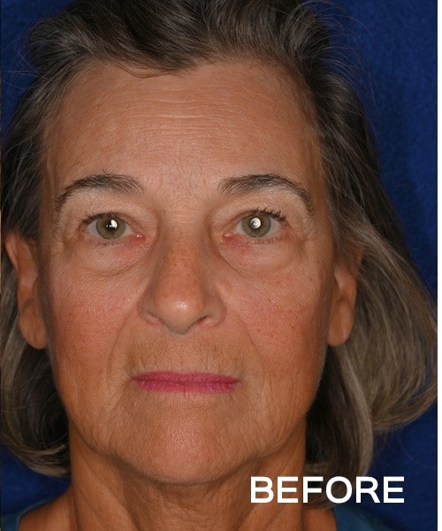Deep Plane Facelift before and after - before