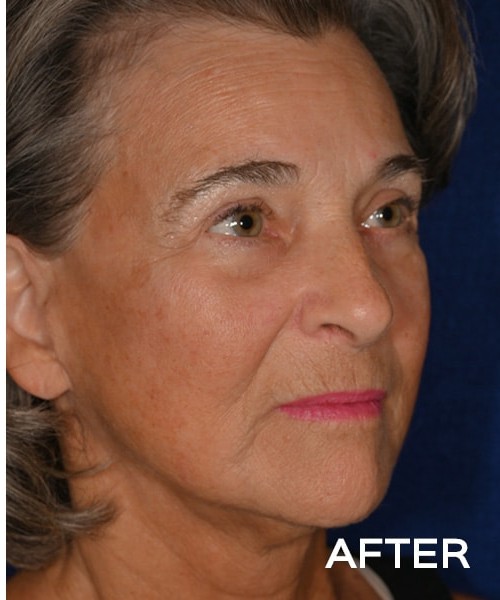 Deep Plane Facelift before and after - after